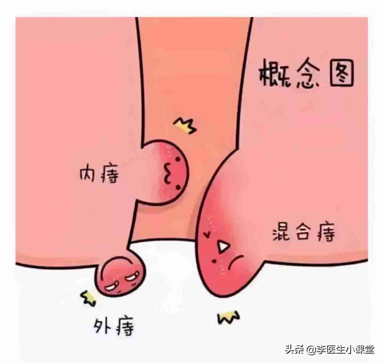 痔疮外痔肉球怎么消除？专家：2个方法这么用，痔疮肉球没有了