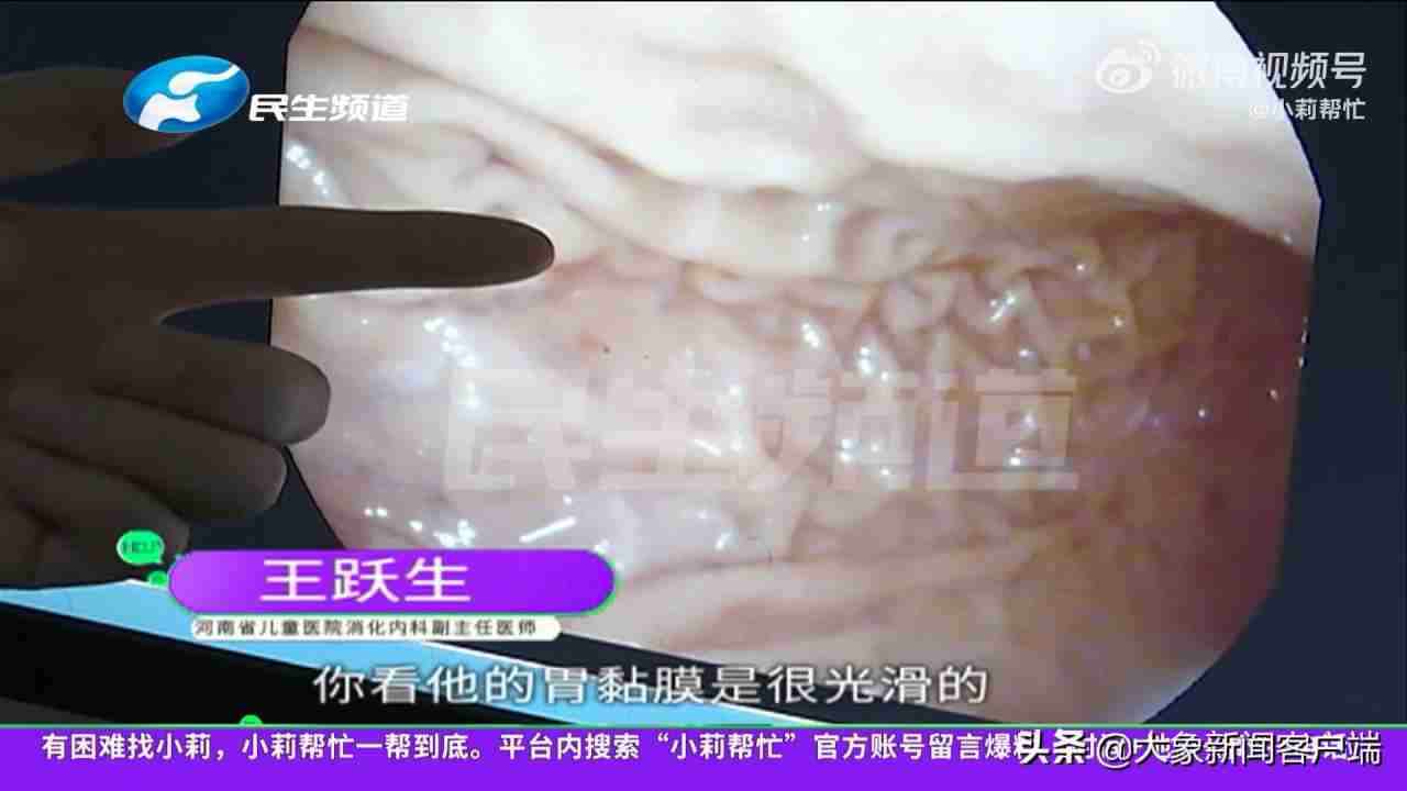 1岁婴儿胃内发现3根6cm长钢钉 究竟是怎么回事?