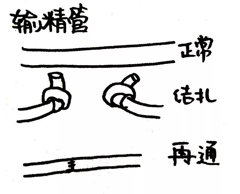 姑娘给男人结扎(女医生主刀做男人结扎案列)