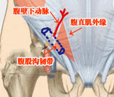 腹股沟在哪个位置图片（男性腹股沟疼痛怎么回事）