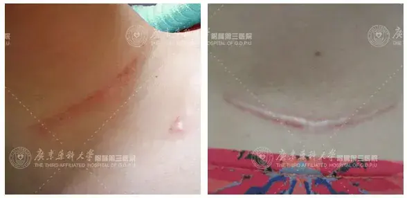 甲状腺术后并发症 甲状腺术后疤痕修复